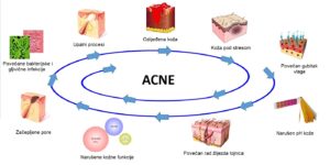 Proces nastajanja Akni